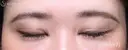 【30代女性・目力を改善】眼瞼下垂手術＋目頭切開（4ヶ月後） 120日後 サムネイル用