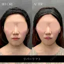 リバーリフト after画像 サムネイル用