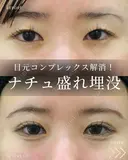 目元コンプレックス解消👀💖 after画像 サムネイル用