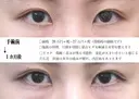 目頭切開法 30日後 サムネイル用