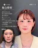鼻整形×目元整形 before画像 サムネイル用