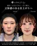 鼻整形×目元整形 after画像 サムネイル用