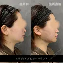 リバー式小顔脂肪吸引 after画像 サムネイル用