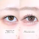 アリエルクイックループトリプル二重埋没法/涙袋ヒアルロン酸 before画像 サムネイル用