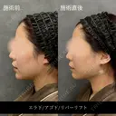 リバー式小顔脂肪吸引 before画像 サムネイル用
