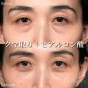 クマ取り(経結膜脱脂法)＋ヒアルロン酸 after画像 サムネイル用