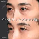 クマ取り(経結膜脱脂法)＋ヒアルロン酸 before画像 サムネイル用