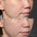 ジュブゼン before画像 サムネイル用