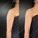 二の腕脂肪吸引 after画像 サムネイル用