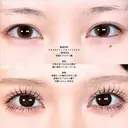 アリエルクイックループトリプル二重埋没法/涙袋ヒアルロン酸  before画像 サムネイル用