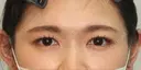 【20代・女性】二重埋没法（マイクロメソッド+α）（１週間後） before画像 サムネイル用