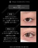 たるみ取り併用全切開法二重術/眼瞼下垂手術/MD式 before画像 サムネイル用