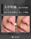人中短縮（MIX型切開）・鼻翼縮小・鼻翼挙上 30日後 サムネイル用