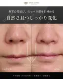 人中短縮（MIX型切開）・鼻翼縮小・鼻翼挙上 before画像 サムネイル用