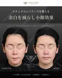 人中短縮（MIX型切開）・鼻翼縮小・鼻翼挙上 30日後 サムネイル用