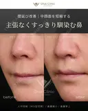 人中短縮（MIX型切開）・鼻翼縮小・鼻翼挙上 before画像 サムネイル用
