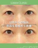 10代からの悩み 原因を見極めて改善 before画像 サムネイル用