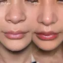 口唇整形－複合－＋鼻整形 before画像 サムネイル用
