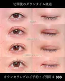 たるみ取り併用全切開法二重術/眼瞼下垂手術/MD式 before画像 サムネイル用