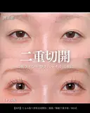 たるみ取り併用全切開法二重術/眼瞼下垂手術/MD式 30日後 サムネイル用