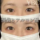 【🍒涙袋ヒアルロン酸🍒】 after画像 サムネイル用
