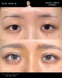 二重埋没（自然癒着法） after画像 サムネイル用