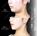 頬・顎下脂肪吸引/ジョール・バッカルファット除去/糸リフト/エラ・顎ボトックス/顎ヒアルロン酸/ before画像 サムネイル用