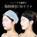 頬・顎下脂肪吸引/ジョール・バッカルファット除去/糸リフト/エラ・顎ボトックス/顎ヒアルロン酸/ 180日後 サムネイル用