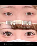 二重埋没法(クイックシンデレラ・トリプル)/ 目頭切開/MD式 30日後 サムネイル用