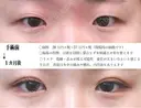 埋没法＋目頭切開法 before画像 サムネイル用