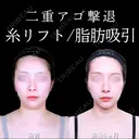 アゴ下脂肪吸引 /糸リフト/アゴヒアルロン酸 180日後 サムネイル用