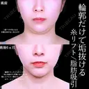 アゴ下脂肪吸引 /糸リフト/アゴヒアルロン酸 before画像 サムネイル用
