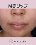 M字リップ before画像 サムネイル用