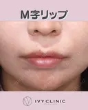 M字リップ after画像 サムネイル用