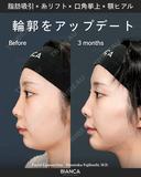 脂肪吸引・糸リフト・口角挙上・ヒアルロン酸・ボトックス after画像 サムネイル用