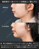 脂肪吸引・糸リフト・口角挙上・ヒアルロン酸・ボトックス after画像 サムネイル用