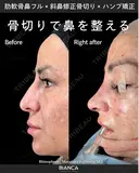 肋軟骨鼻フル・斜鼻修正骨切り・ハンプ矯正 after画像 サムネイル用