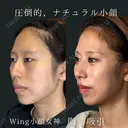 Wing小顔女神脂肪吸引 90日後 サムネイル用