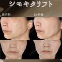 糸リフト８本 30日後 サムネイル用