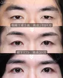 【40代男性・凛々しい目元に】眼瞼下垂＋眉下リフト（1年8ヶ月後） 515日後 サムネイル用