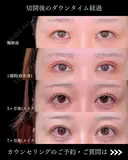 全切開二重術/眼瞼下垂手術/眉下切開/目頭切開/MD式 before画像 サムネイル用