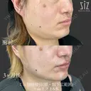 【ミニ脂肪吸引】明後日から仕事... before画像 サムネイル用
