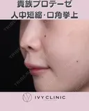 貴族プロテーゼ　人中短縮　口角挙上 before画像 サムネイル用