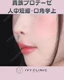 貴族プロテーゼ　人中短縮　口角挙上 after画像 サムネイル用