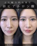 Cカールリップ before画像 サムネイル用
