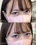 涙袋ヒアルロン酸 after画像 サムネイル用
