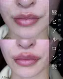 Cカールリップ before画像 サムネイル用