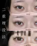 二重埋没法 after画像 サムネイル用