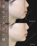 顎ヒアルロン酸 before画像 サムネイル用