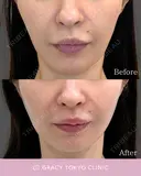 ミニ切開リフト before画像 サムネイル用